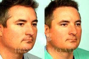 Chin Liposuction By Dr. Frank Agullo, MD, Plastic Surgeon In El Paso, Texas (1)