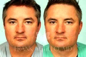 Chin Liposuction By Dr. Frank Agullo, MD, Plastic Surgeon In El Paso, Texas (2)