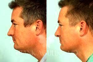 Chin Liposuction By Dr. Frank Agullo, MD, Plastic Surgeon In El Paso, Texas (3)