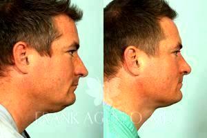 Chin Liposuction By Dr. Frank Agullo, MD, Plastic Surgeon In El Paso, Texas (4)
