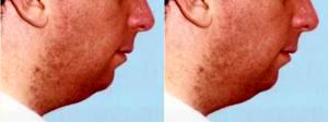 Chin Liposuction By Dr. Joseph M. Arzadon, MD, Arlington, VA Plastic Surgeon