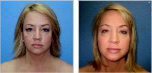 Chin Liposuction By W. Tracy Hankins, MD, Doctor In The Clark County, Nevada (1)