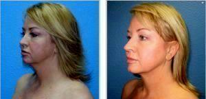 Chin Liposuction By W. Tracy Hankins, MD, Doctor In The Clark County, Nevada (2)