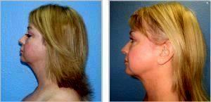 Chin Liposuction By W. Tracy Hankins, MD, Doctor In The Clark County, Nevada (3)