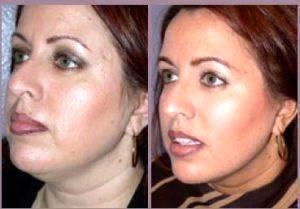 Dr Hayley Brown, MD, Plastic Surgeon In The Clark County, Nevada - Chin Lipo (1)