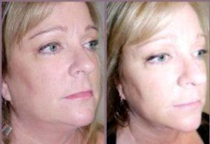 Dr Hayley Brown, MD, Plastic Surgeon In The Clark County, Nevada - Chin Lipo (2)