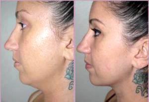 Dr Hayley Brown, MD, Plastic Surgeon In The Clark County, Nevada - Submental Liposuction (1)