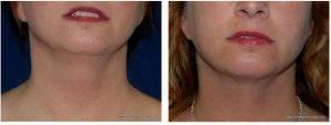 Dr Mahlon Kerr, MD, FACS, Austin Plastic Surgeon - Neck Liposuction Before And After