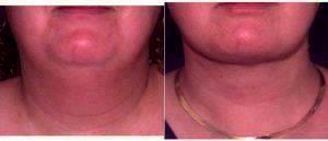 Dr. Richard Sadove, MD, Gainesville Plastic Surgeon - 40 Year Old Woman Treated With Neck Liposuction