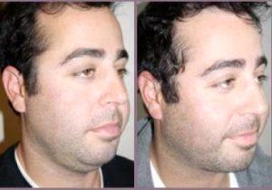 Male Neck Lipo By Dr Hayley Brown, MD, Plastic Surgeon In The Clark County, Nevada