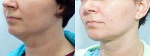 Neck Lipo By Dr. Keith C. Neaman, MD, Surgeon In Salem, Oregon (1)