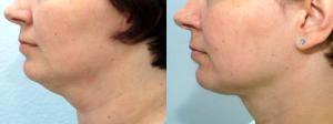 Neck Lipo By Dr. Keith C. Neaman, MD, Surgeon In Salem, Oregon (2)