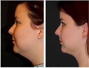 Neck Liposuction By Dr. Frederick G. Weniger, MD, FACS, Plastic Surgeon In Savannah, Georgia