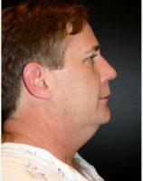 49 Year Old Man Treated With Chin Liposuction By Dr. Julie E. Voss, MD, Kirkland Dermatologic Surgeon