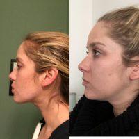 Chin Liposuction In Panama City Before And After