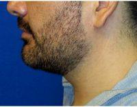 Doctor Raymond E. Lee, MD, Orange County Facial Plastic Surgeon - 32 Year Old Man Treated With Chin Liposuction