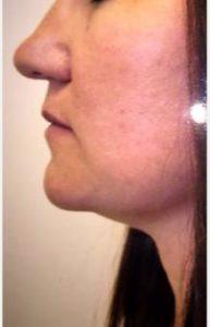 Dr Steven H. Wiener, MD, Scottsdale Plastic Surgeon - 34 Year Old Woman Treated With Chin Liposuction