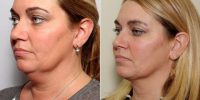39 Year Old Woman Treated With Chin Liposuction Before By Dr. Charles R. Nathan, MD, FACS, Saint Louis Plastic Surgeon