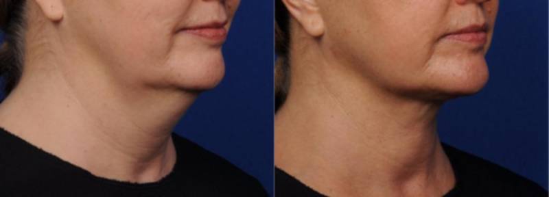Year Old Mrs Treated With Cool Lipo For Neck Picture By Doctor