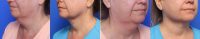 54 Year Old Woman Treated With Neck Liposuction Before With Doctor Sarah A. Mess, MD, Columbia Plastic Surgeon