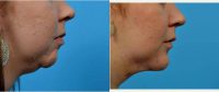 Doctor P. Daniel Ward, MD, Salt Lake City Facial Plastic Surgeon - 24 Year Old Woman Treated With Chin Liposuction Before