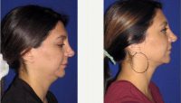 _Double Chin_ Correction With Smart Lipo Before By Dr Anthony Corrado, DO, Philadelphia Facial Plastic Surgeon 873