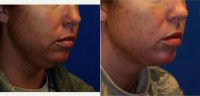 Dr Sang W. Kim, MD, Syracuse Facial Plastic Surgeon - 34 Year Old Woman Treated With Chin Liposuction
