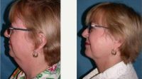 Neck Liposuction Before With Doctor Suzanne M. Quardt, MD, Palm Springs Plastic Surgeon