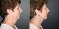 Woman Treated With Chin Liposuction Before With Dr Ludwig A. Allegra, MD, Seattle Facial Plastic Surgeon
