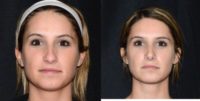 26 year old woman treated with Rhinoplasty