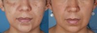 25-34 year old woman treated with Melasma Treatment
