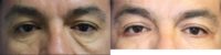 35-44 year old man treated with Eyelid Surgery