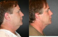 45-54 year old man treated with Chin Liposuction