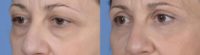 45-54 year old woman treated with Eyelid Surgery