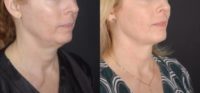 51 year old woman treated with FaceTite