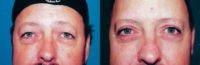 45-54 year old woman treated with Upper Blepharoplasty