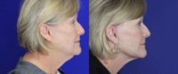 55-64 year old woman face and neck lift under local