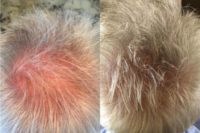 55-64 year old man treated with Hair Loss Treatment