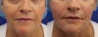59 year old woman treated with Bellafill for volume loss to mid face