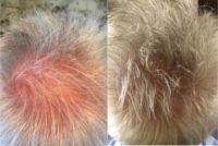 55-64 year old man treated with Hair Loss Treatment