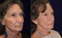 55-64 year old woman treated with Laser Treatment