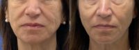 55-64 year old woman treated with Skin Rejuvenation, Dermal Fillers