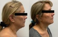 55-64 year old woman treated with FaceTite