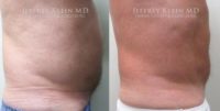55-64 year old man treated with SculpSure