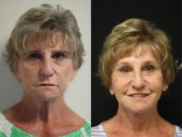 55-64 year old woman treated with Facelift