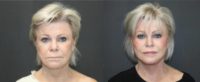 65-74 year old woman treated with Facelift, Facial Fat Transfer