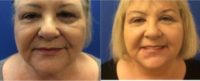 72 year old woman treated with Lower Facelift