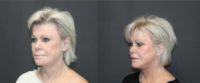 65-74 year old woman treated with Facial Fat Transfer