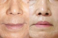 A woman treated with Lip Lift