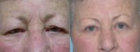 Upper Eyelid Surgery